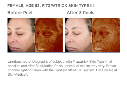 What is the Difference Between a Light, Medium, and Deep Chemical Peel?